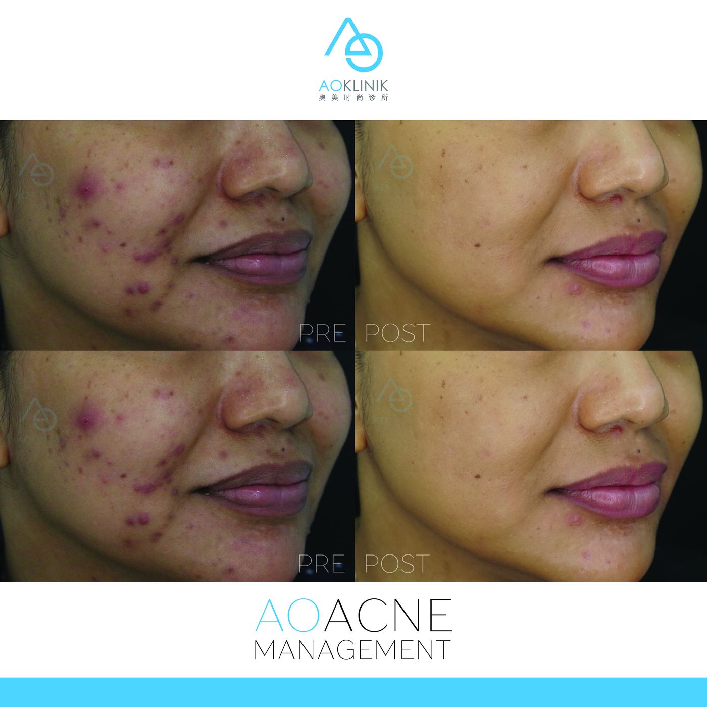 AO Acne Management before and after at AOKLINIK Penang