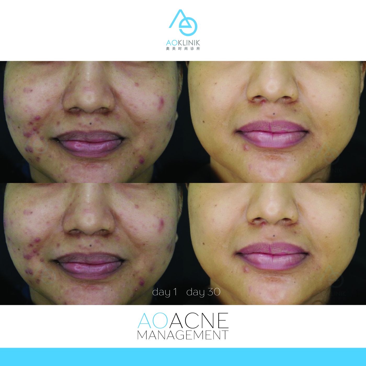 AO Acne Management before and after at AOKLINIK Penang