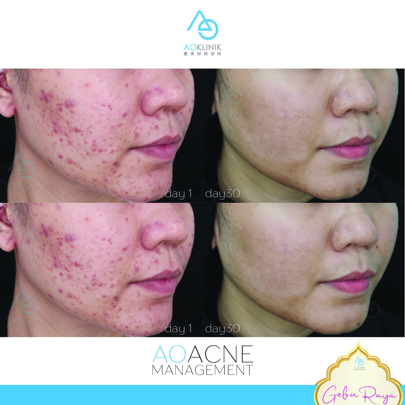 AO Acne Management before and after at AOKLINIK Penang