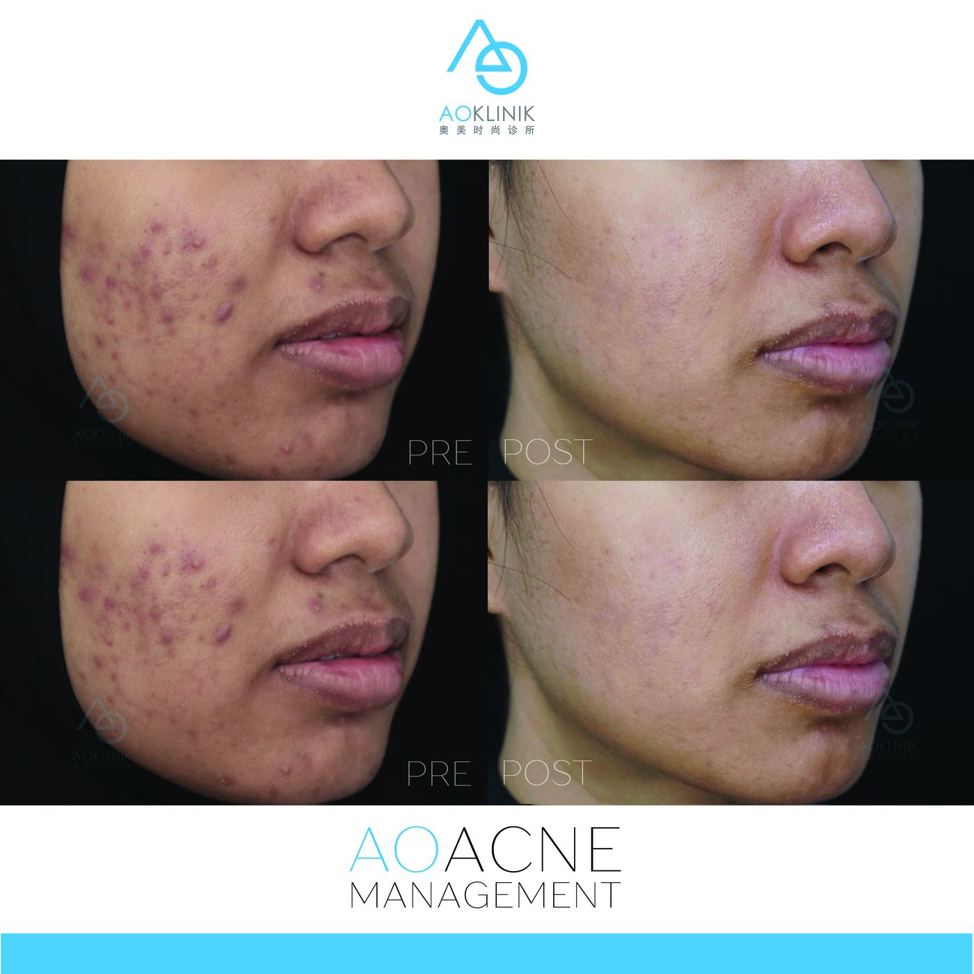 AO Acne Management before and after at AOKLINIK Penang