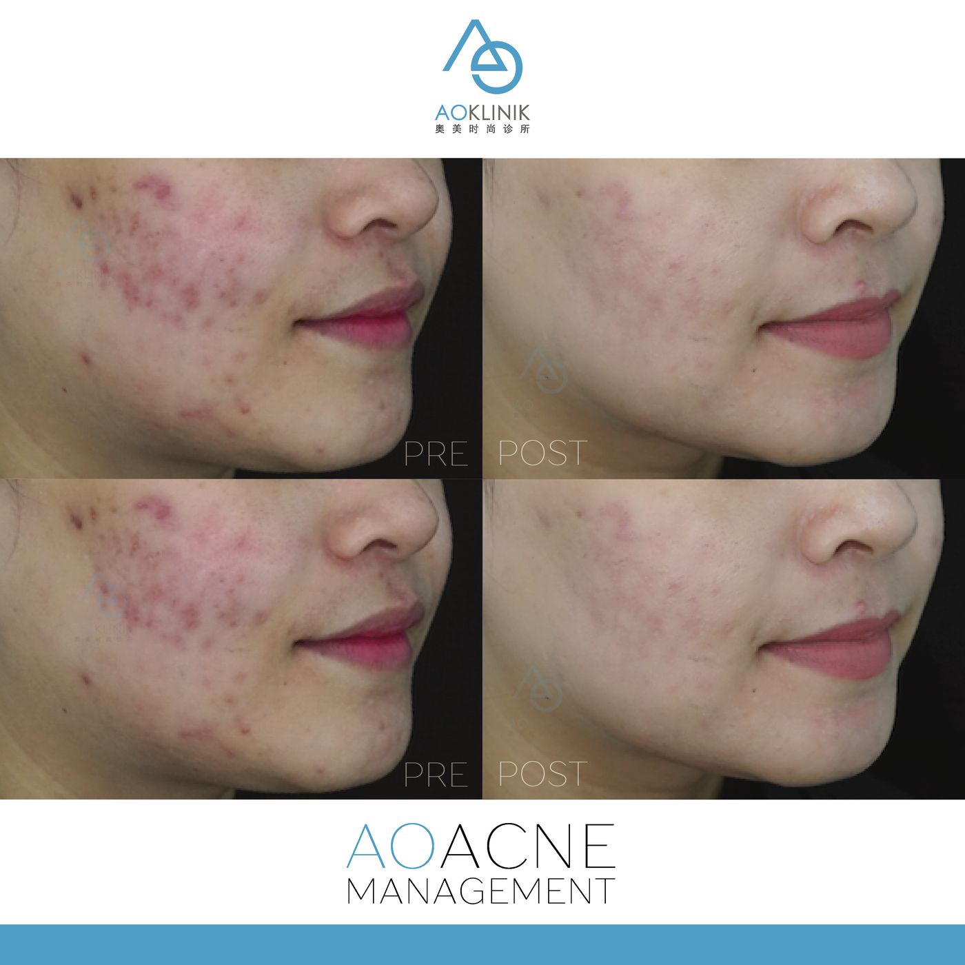 AO Acne Management before and after at AOKLINIK Penang