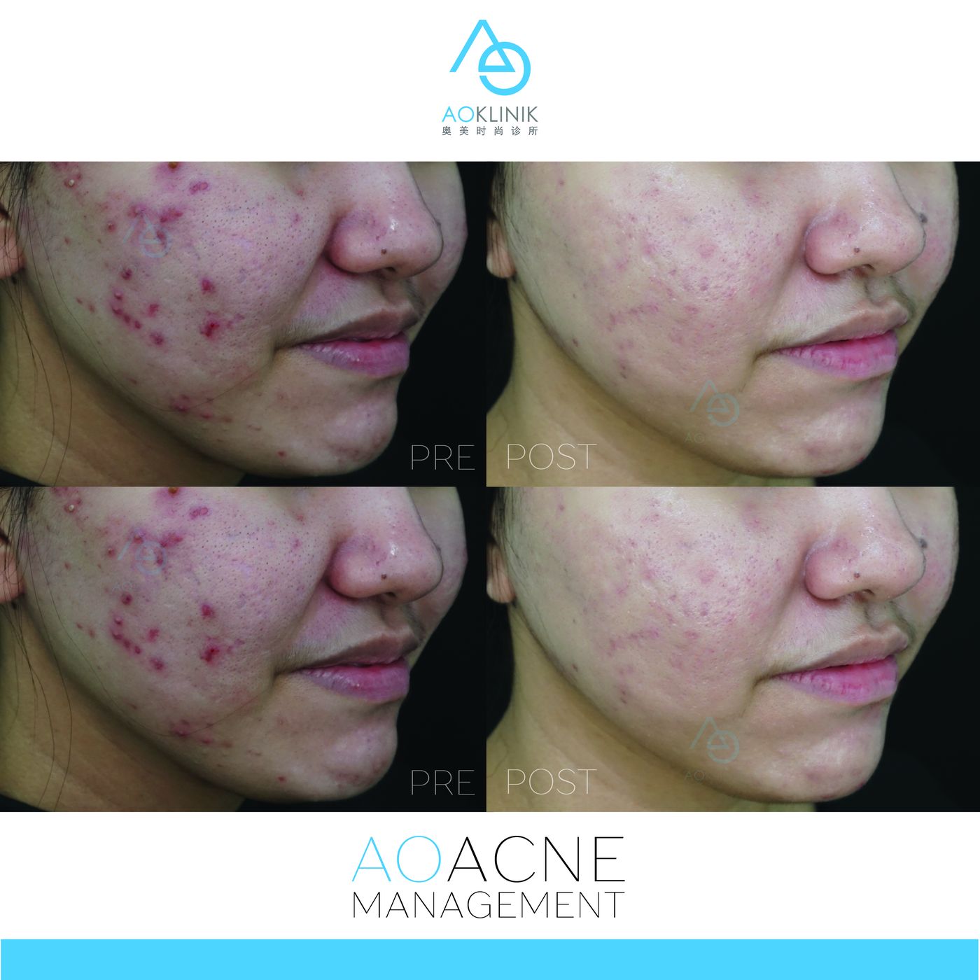 AO Acne Management before and after at AOKLINIK Penang