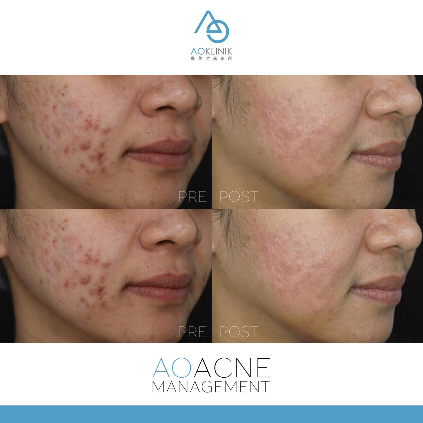Acne & Post-Acne Care before and after at AOKLINIK Penang