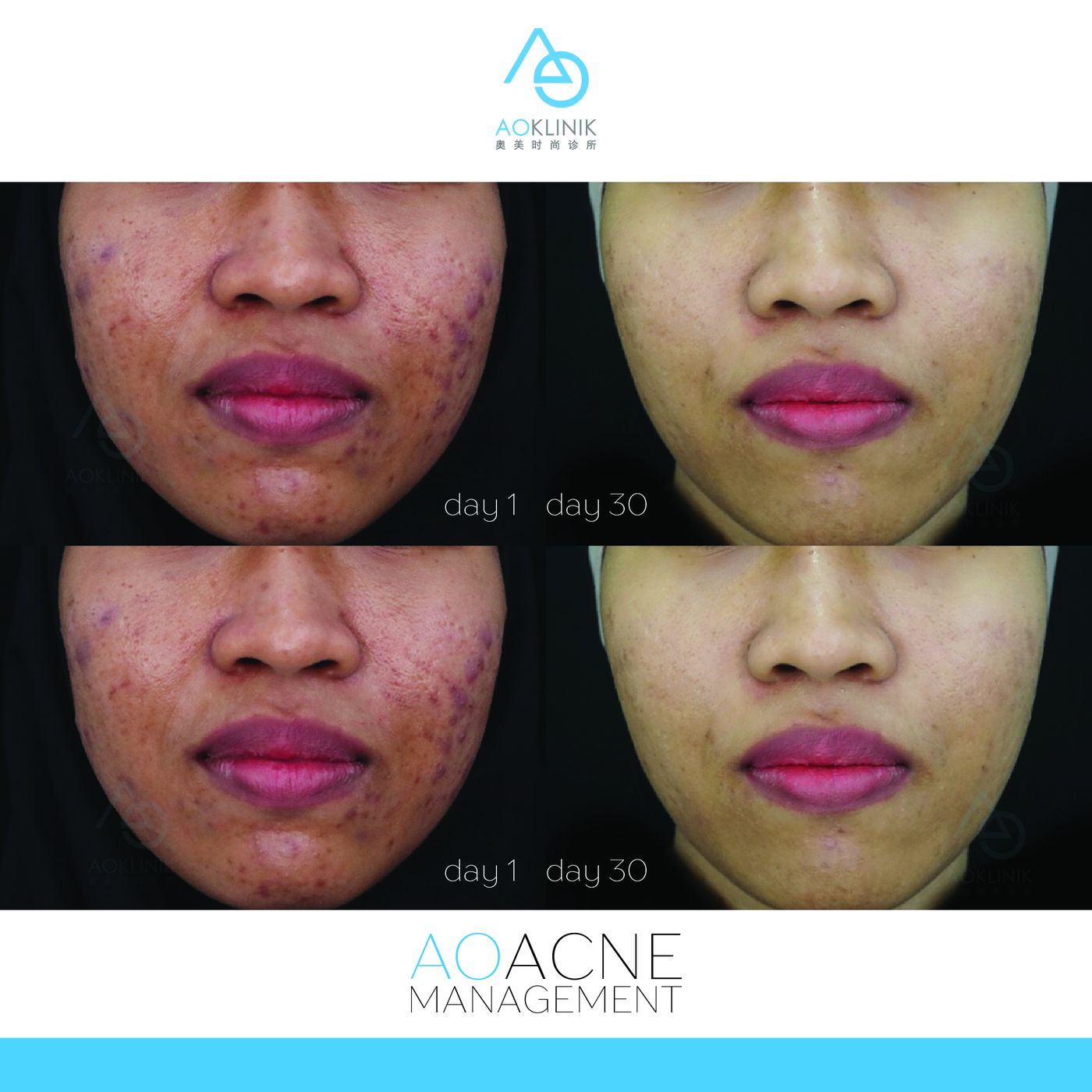 AO Acne Management before and after at AOKLINIK Penang