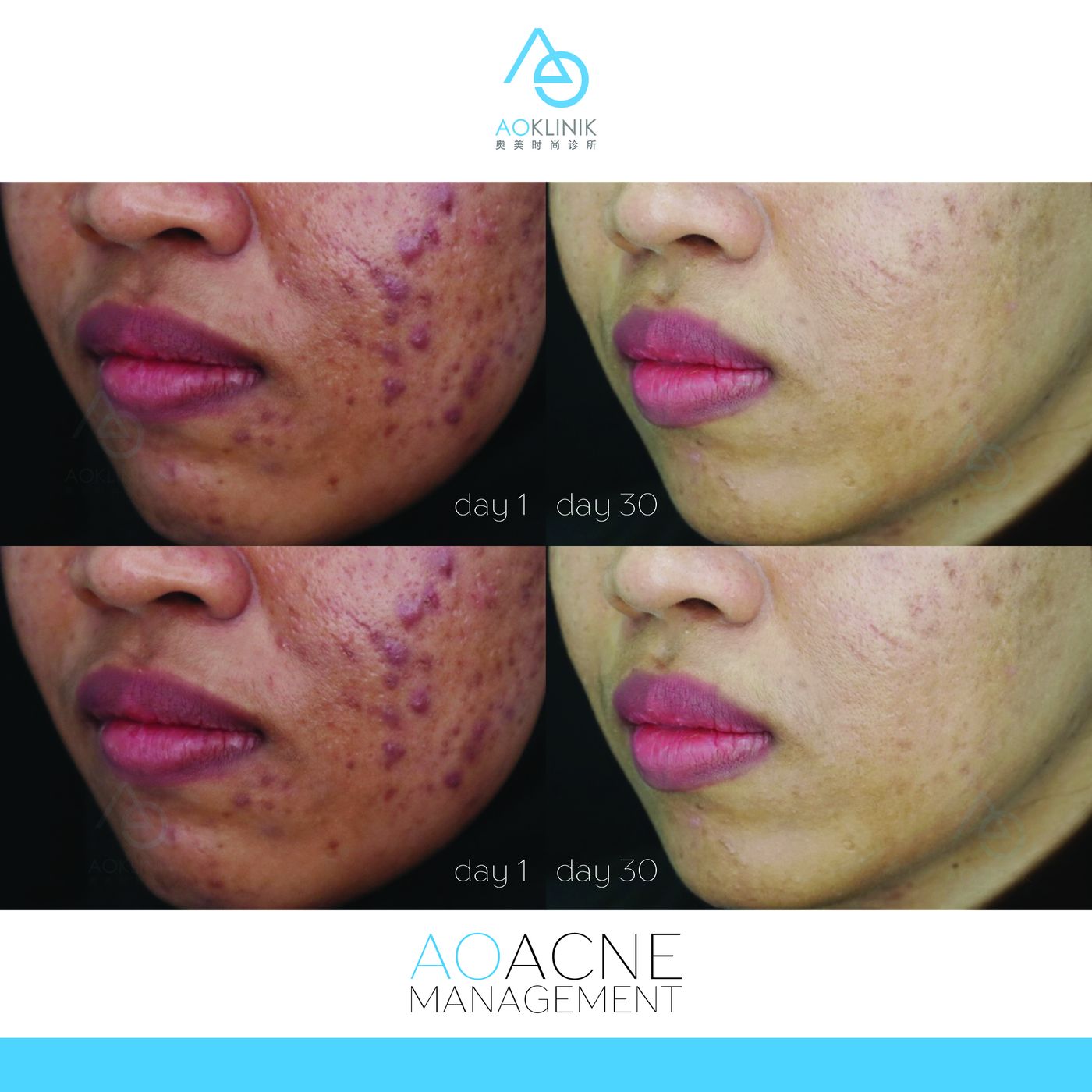 AO Acne Management before and after at AOKLINIK Penang