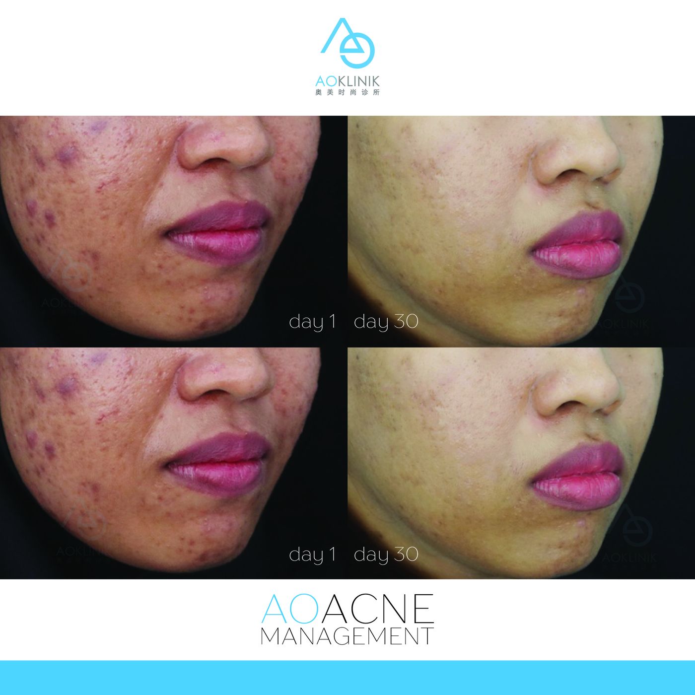 AO Acne Management before and after at AOKLINIK Penang