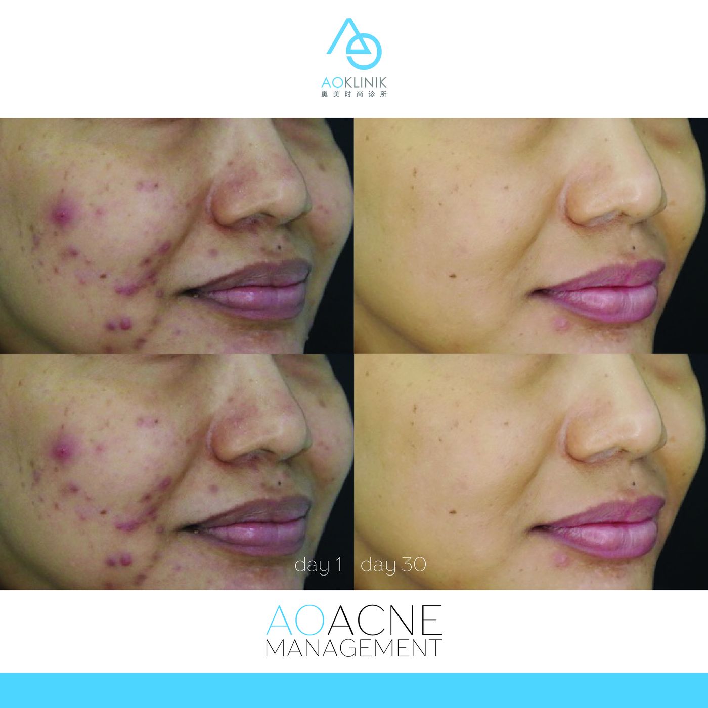 AO Acne Management before and after at AOKLINIK Penang