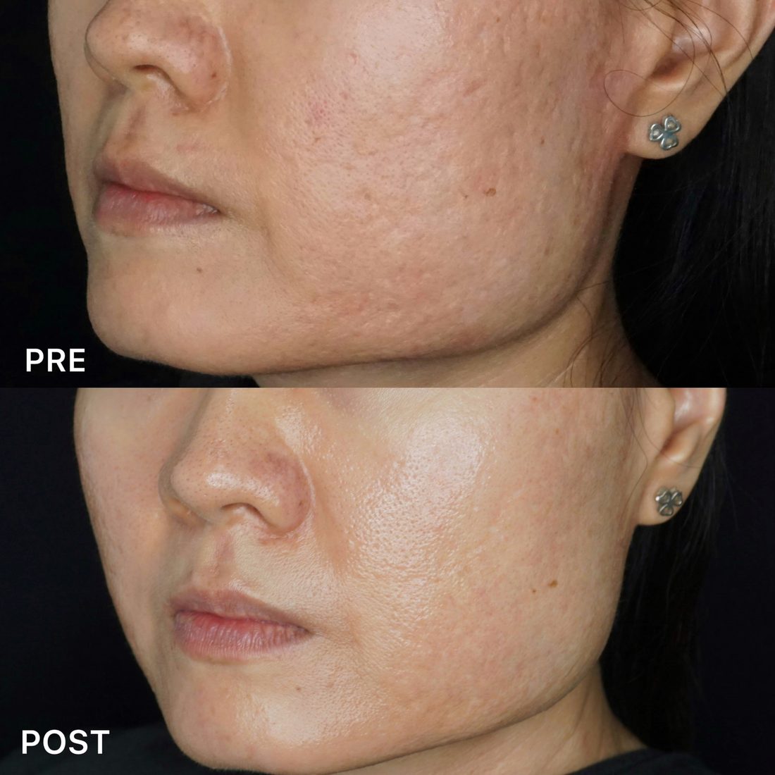 Acne scarring treatment results at AOKLINIK Penang