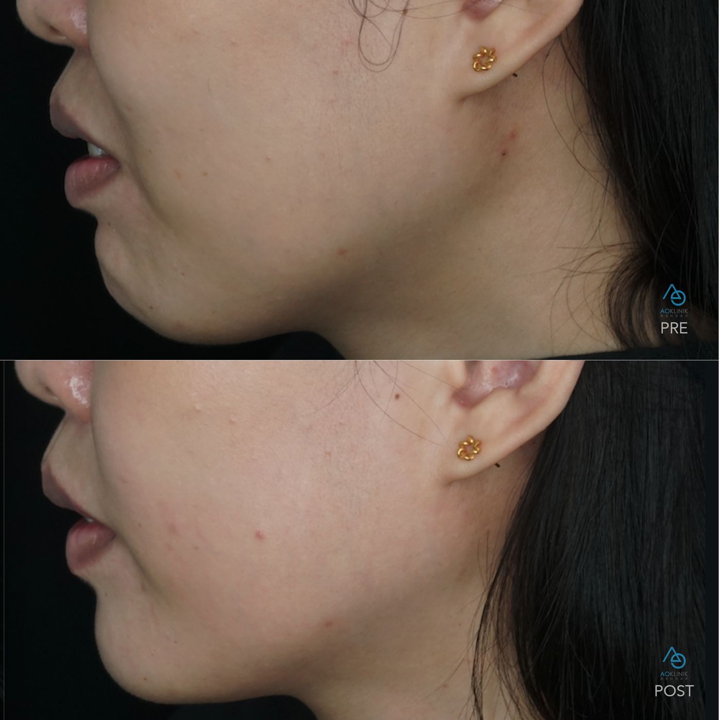 BTX LipFlip before and after at AOKLINIK Penang