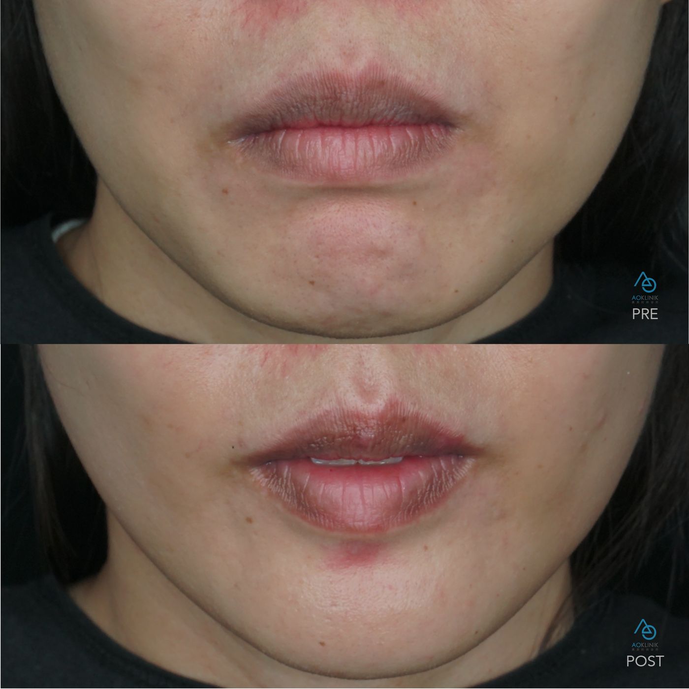 BTX LipFlip before and after at AOKLINIK Penang