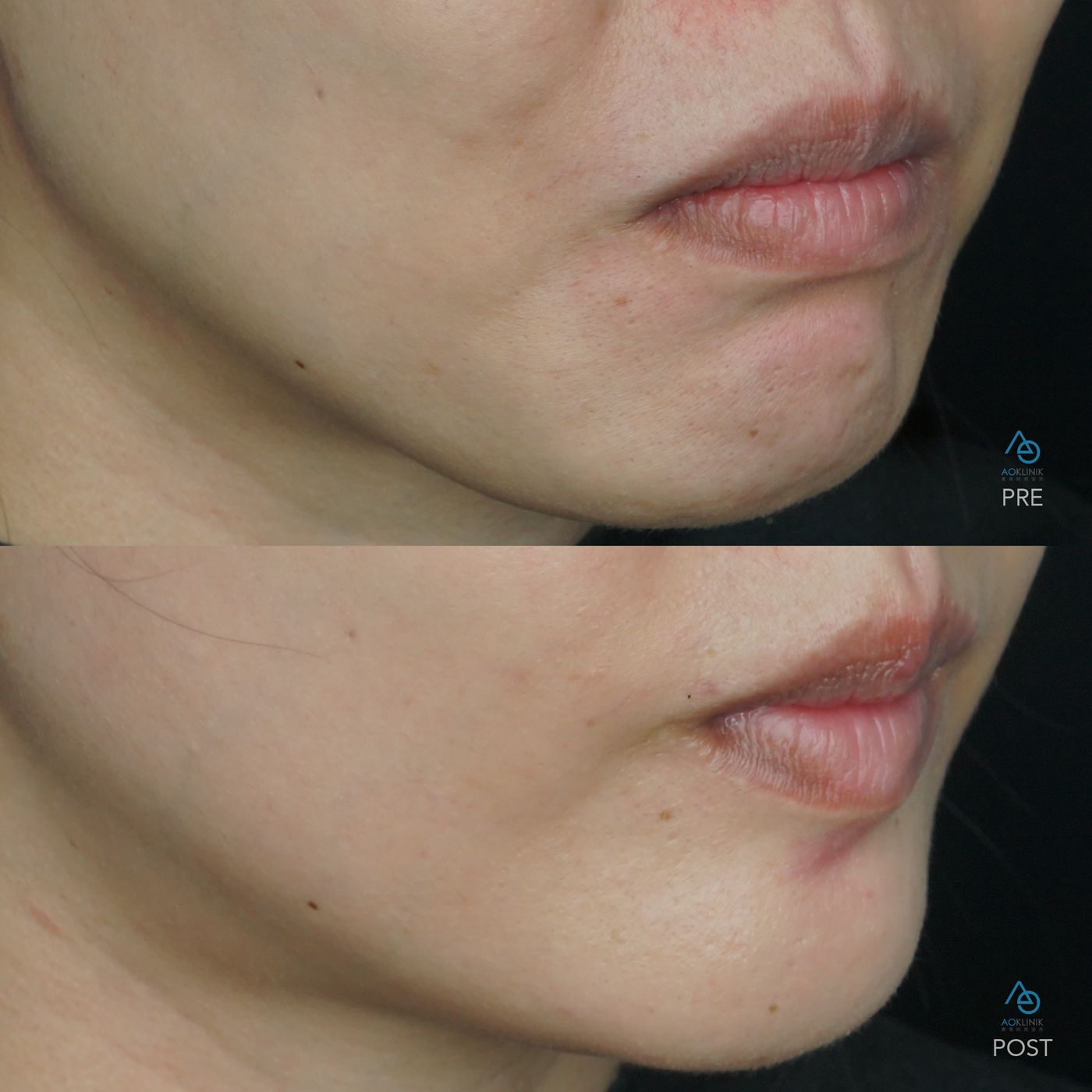 BTX LipFlip before and after at AOKLINIK Penang
