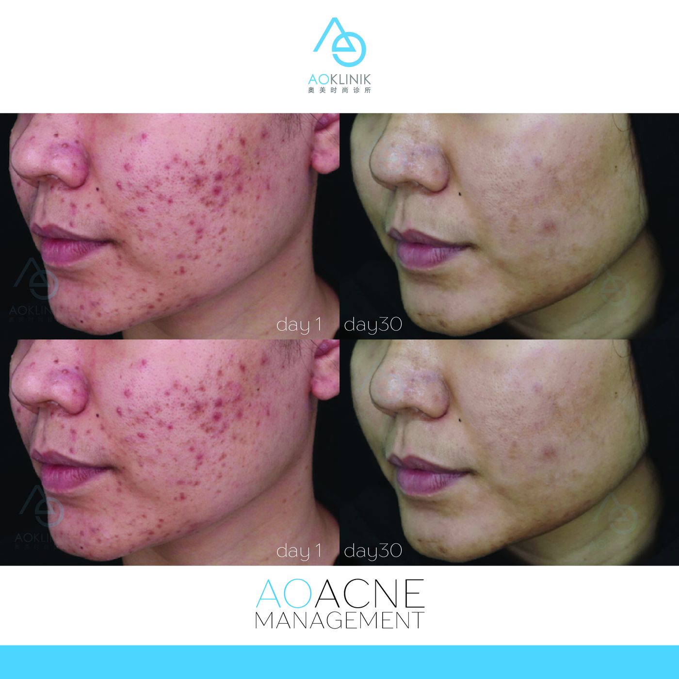 Peel Series: Post-Acne before and after at AOKLINIK Penang