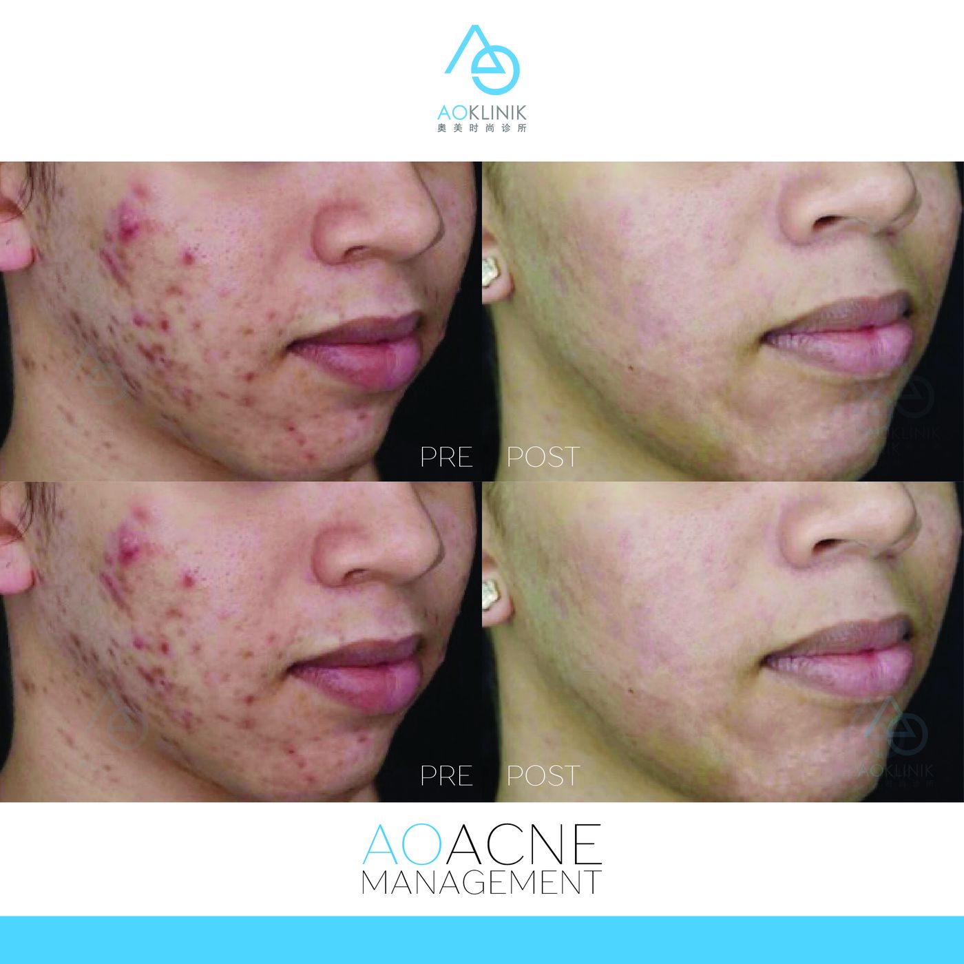 Peel Series: Post-Acne before and after at AOKLINIK Penang