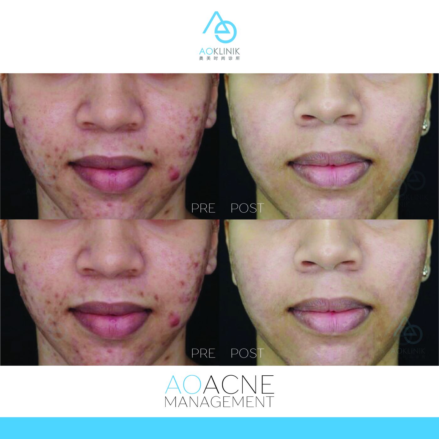 Peel Series: Post-Acne before and after at AOKLINIK Penang