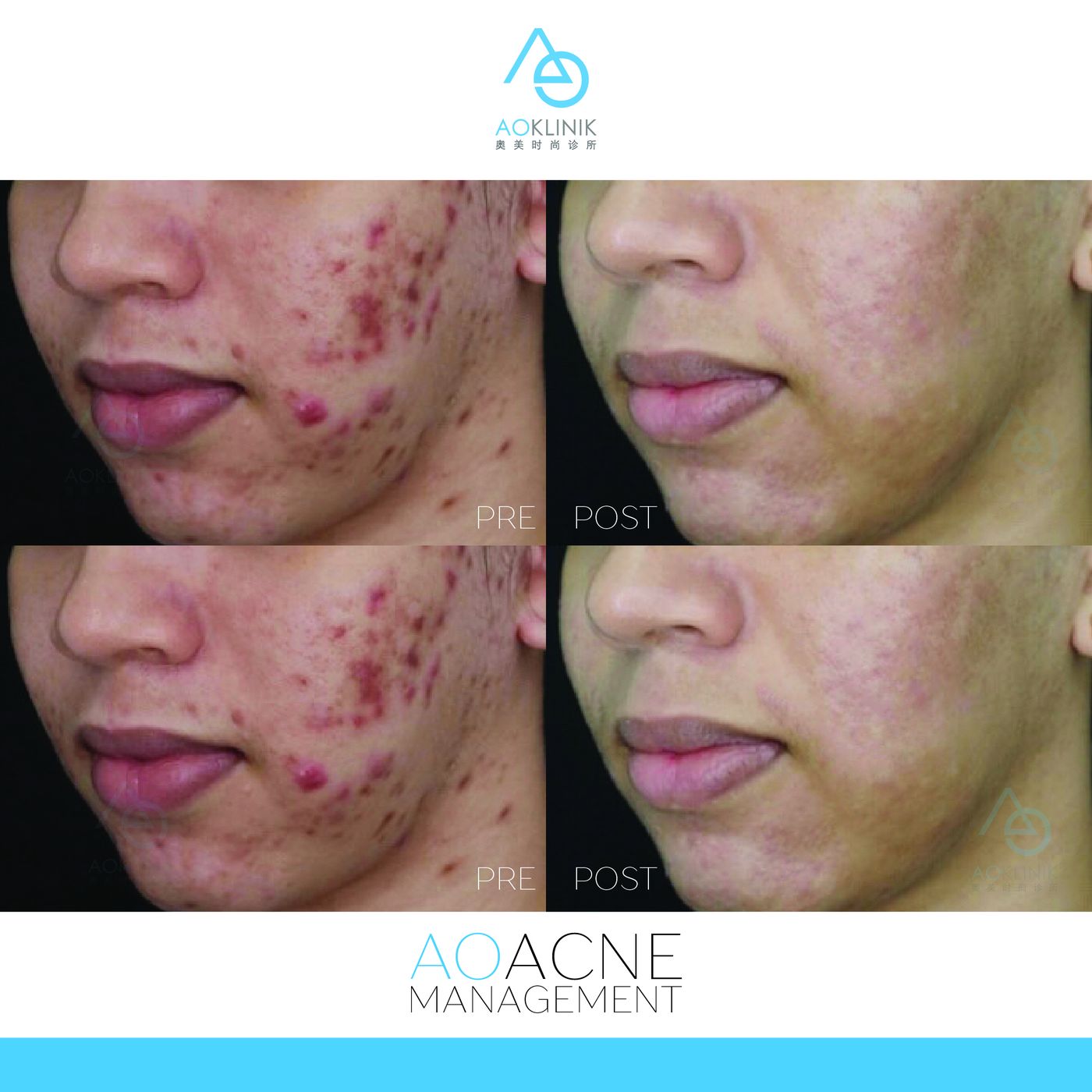 Skin texture treatment before and after for men, AOKLINIK Penang