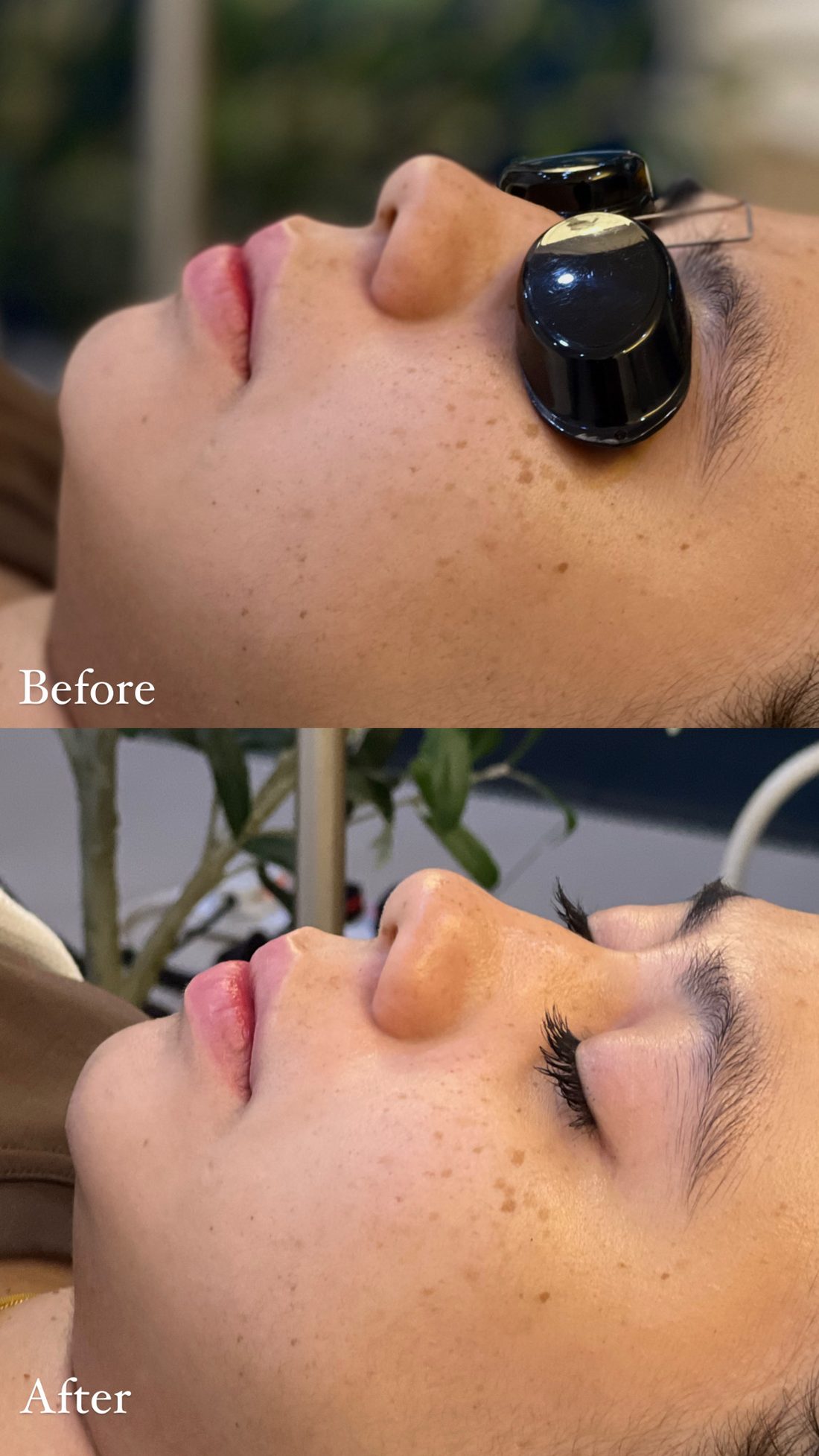 Chemical peel glow and tone result, AOKLINIK Penang