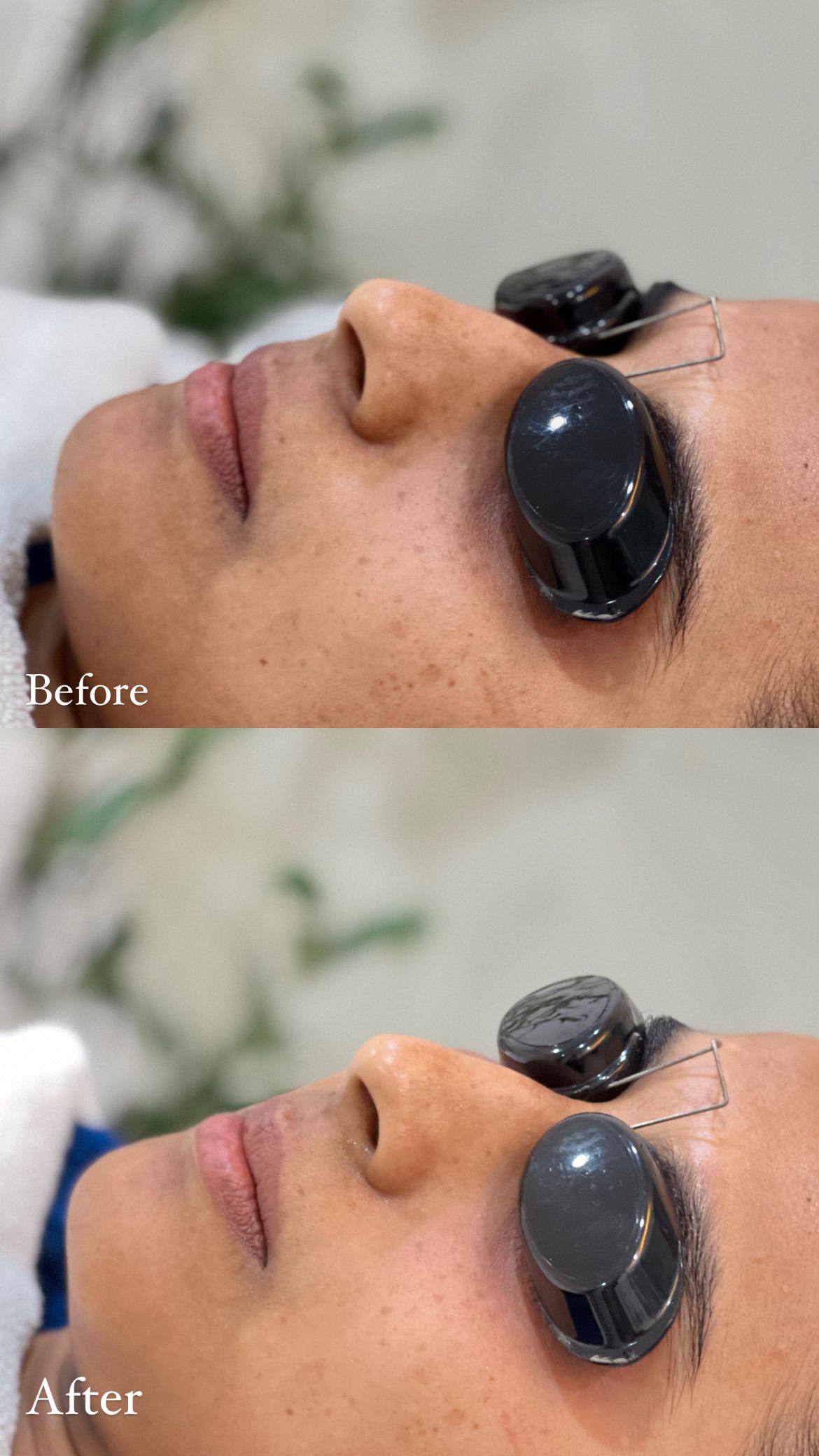 Medical Peel: Tone & Spots before and after at AOKLINIK Penang