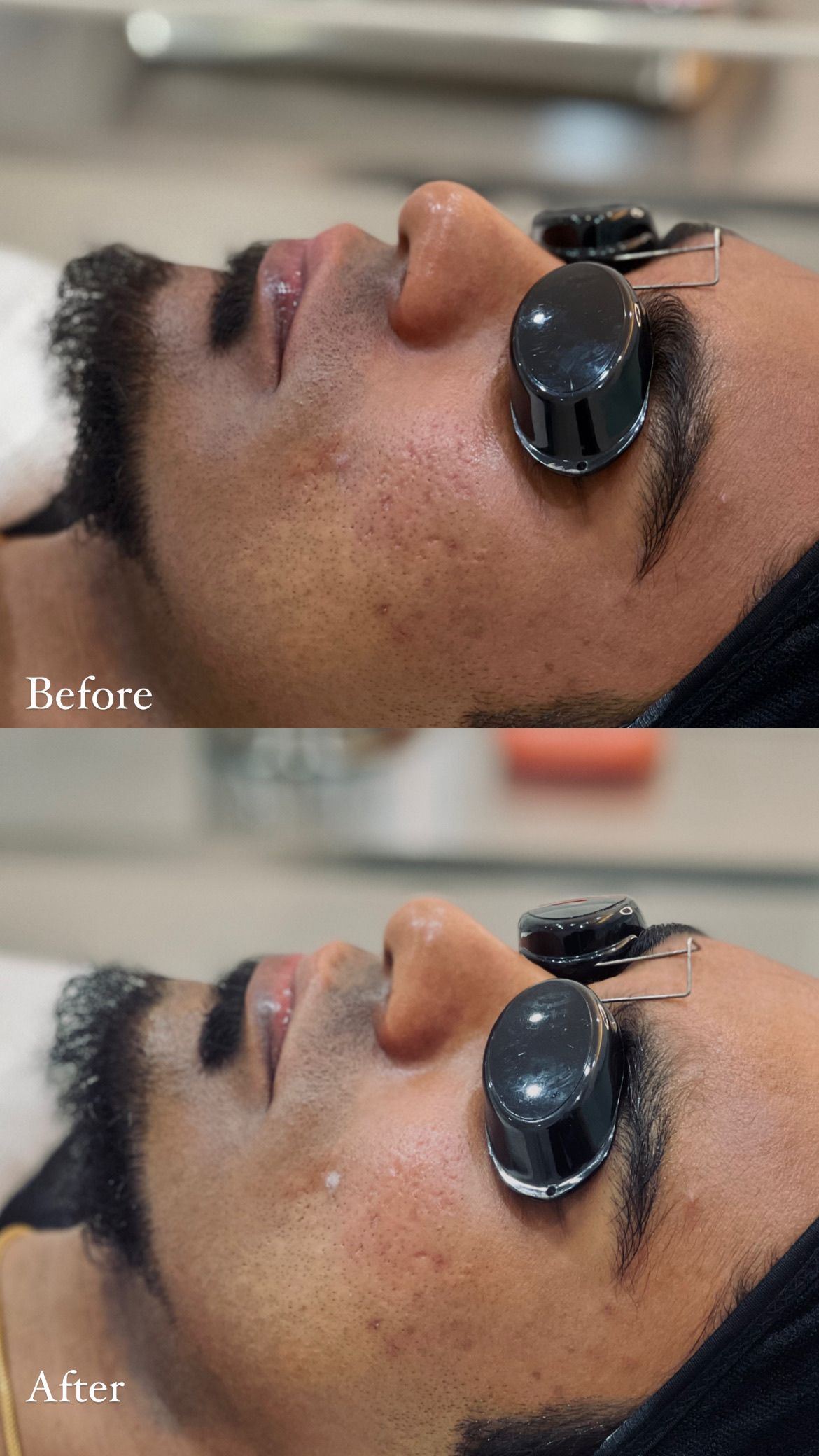 Medical Peel: Texture before and after at AOKLINIK Penang