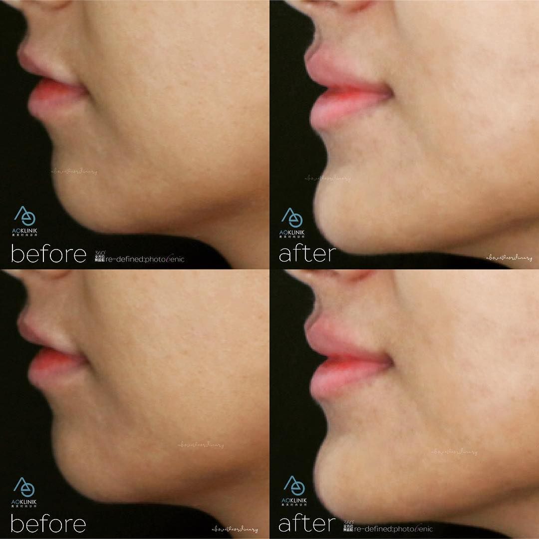 Chin & Jawline Refinement before and after at AOKLINIK Penang