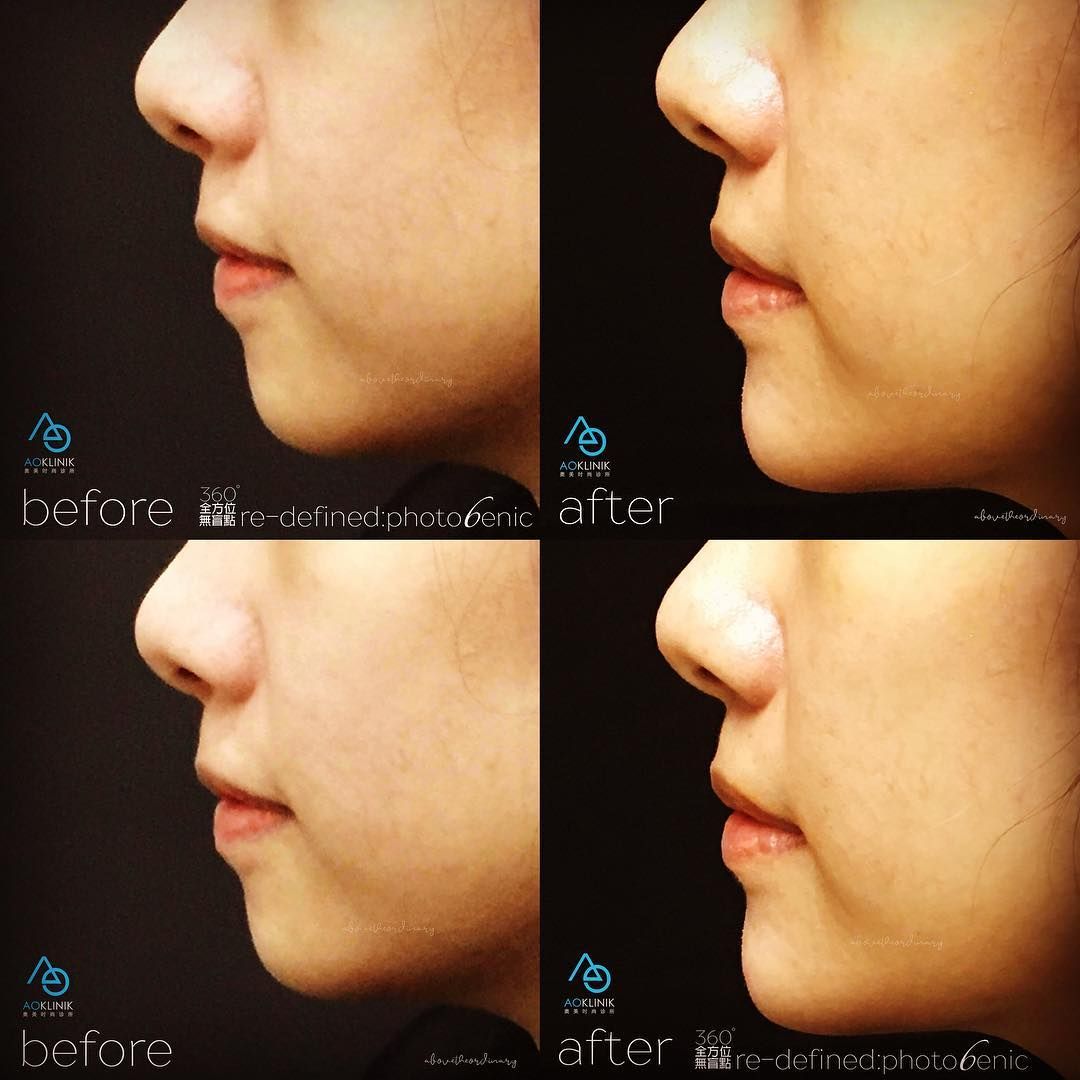 Profile Harmonisation before and after at AOKLINIK Penang