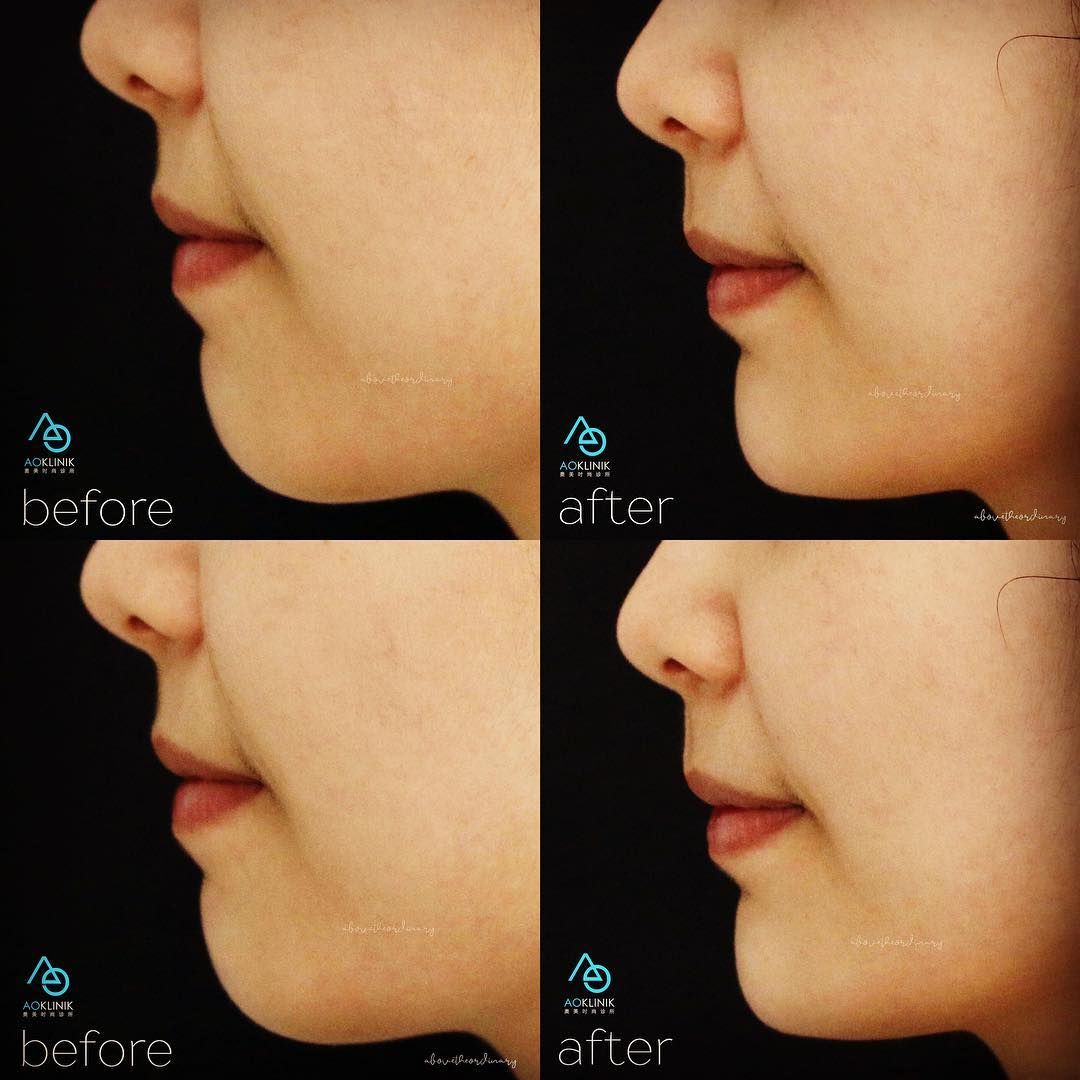 Lower Face Refinement before and after at AOKLINIK Penang