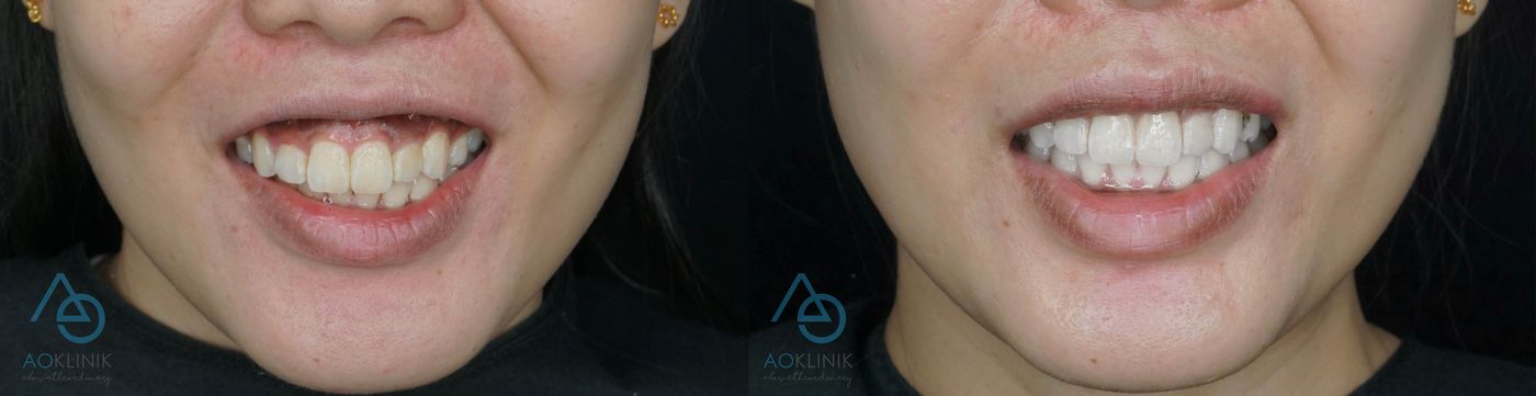 Gummy Smile Correction before and after at AOKLINIK Penang