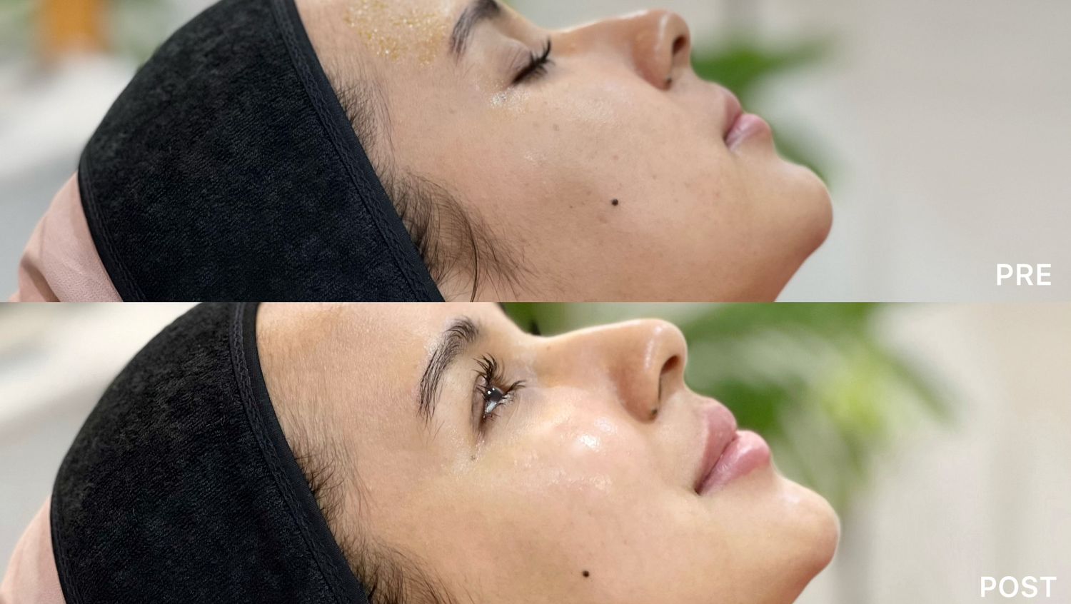 Illumina Peel: Instant Glow before and after at AOKLINIK Penang