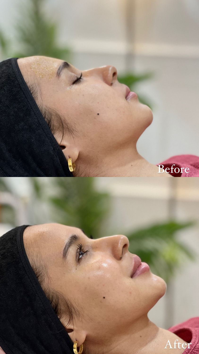 Illumina Peel: Brightening before and after at AOKLINIK Penang