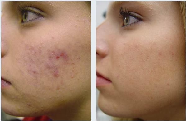 Illustrative acne clearance result