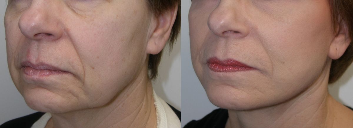 Illustrative lower-face bio-stimulation result