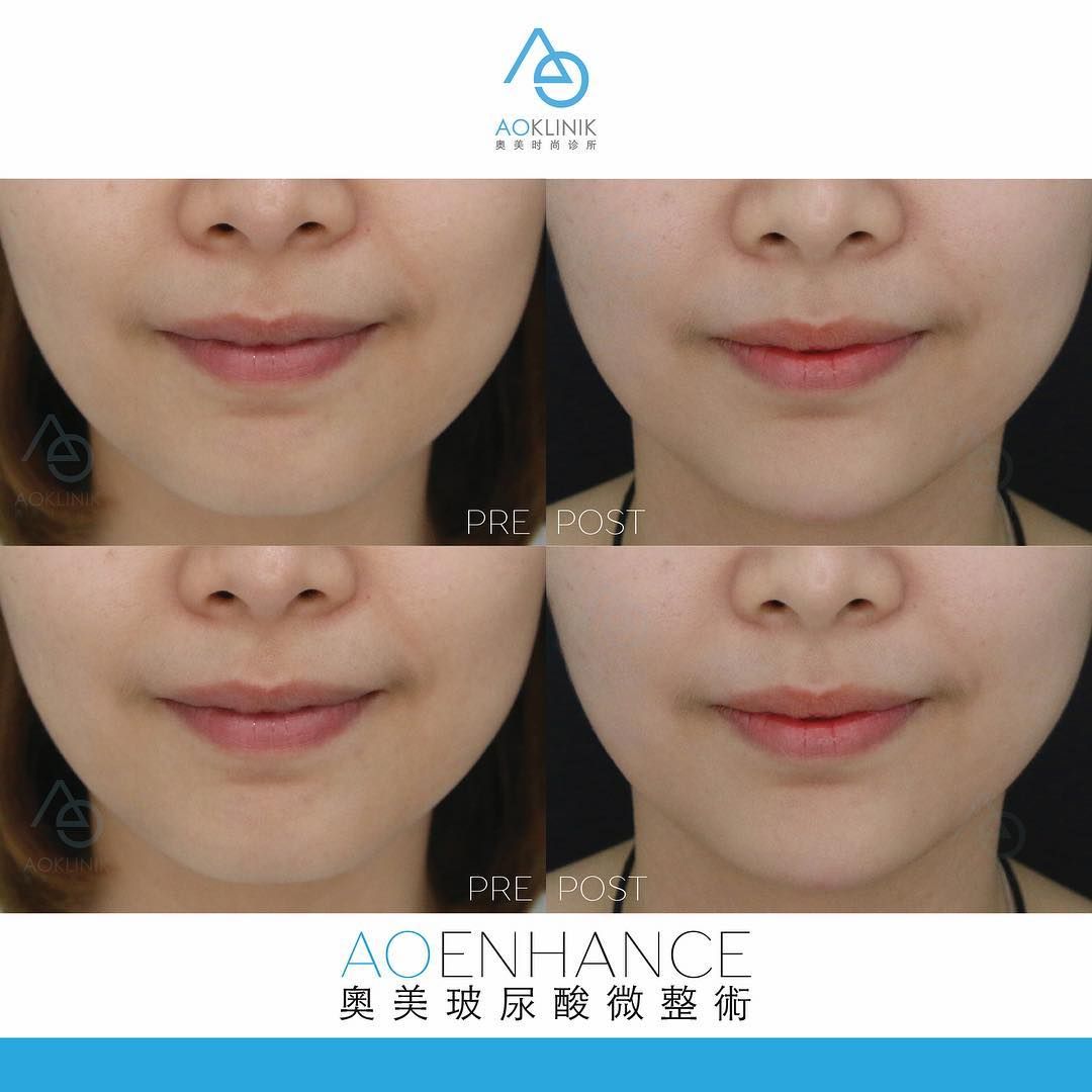 AO Enhance: Lips before and after at AOKLINIK Penang