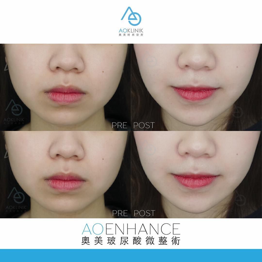 AO Enhance: Lips before and after at AOKLINIK Penang
