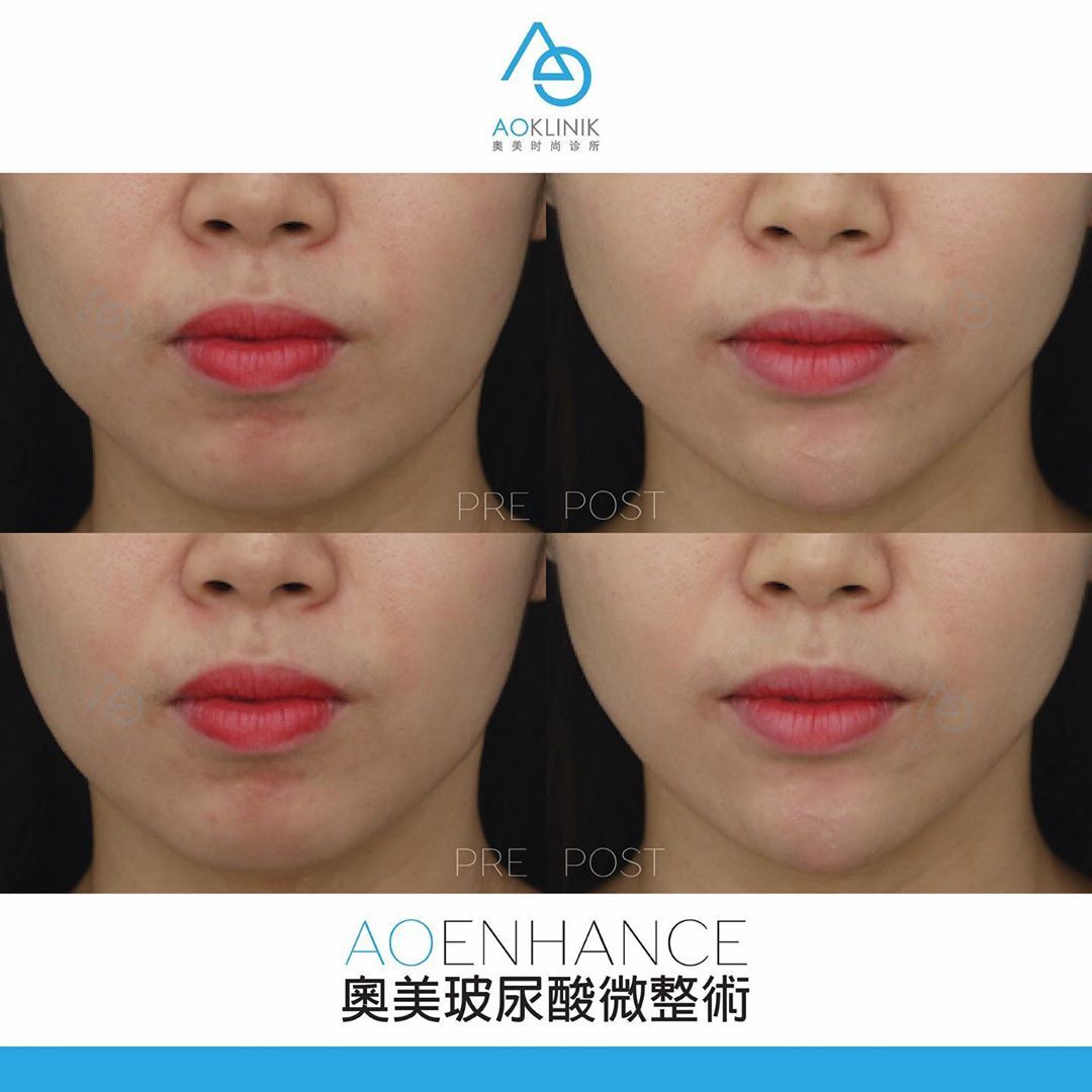 AO Enhance: Lips before and after at AOKLINIK Penang