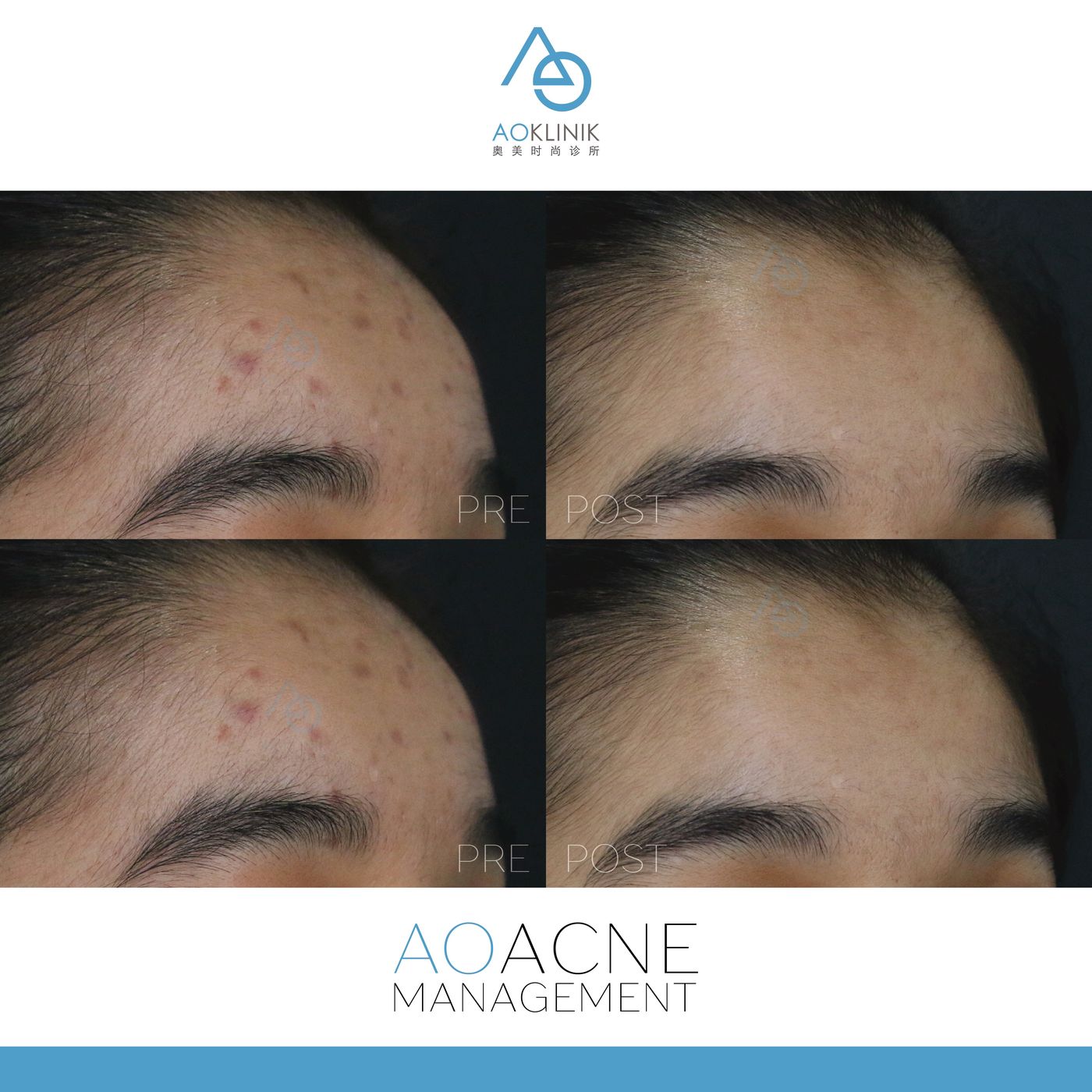 Pigmentation: Forehead Spots before and after at AOKLINIK Penang