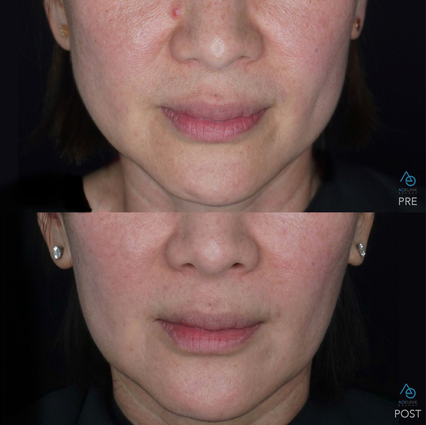 Radiesse Bio-Stimulation before and after at AOKLINIK Penang