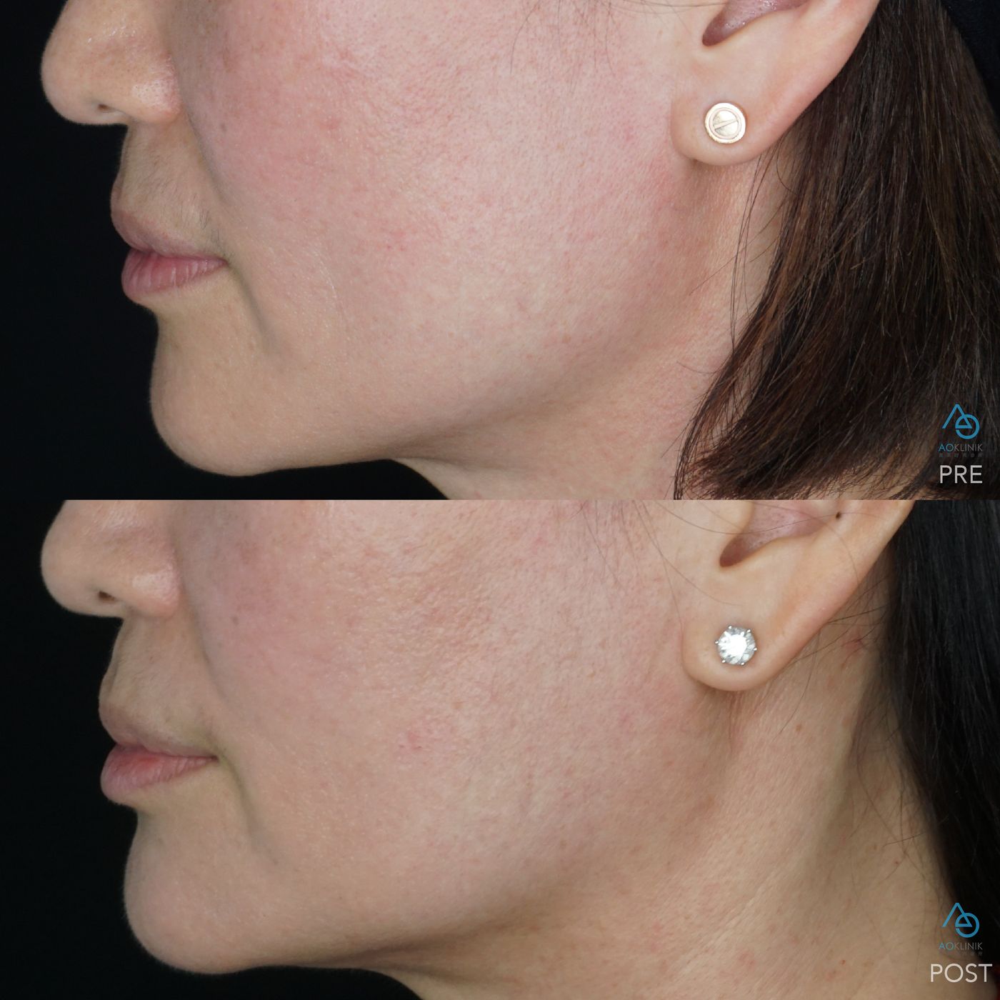 Radiesse Bio-Stimulation before and after at AOKLINIK Penang