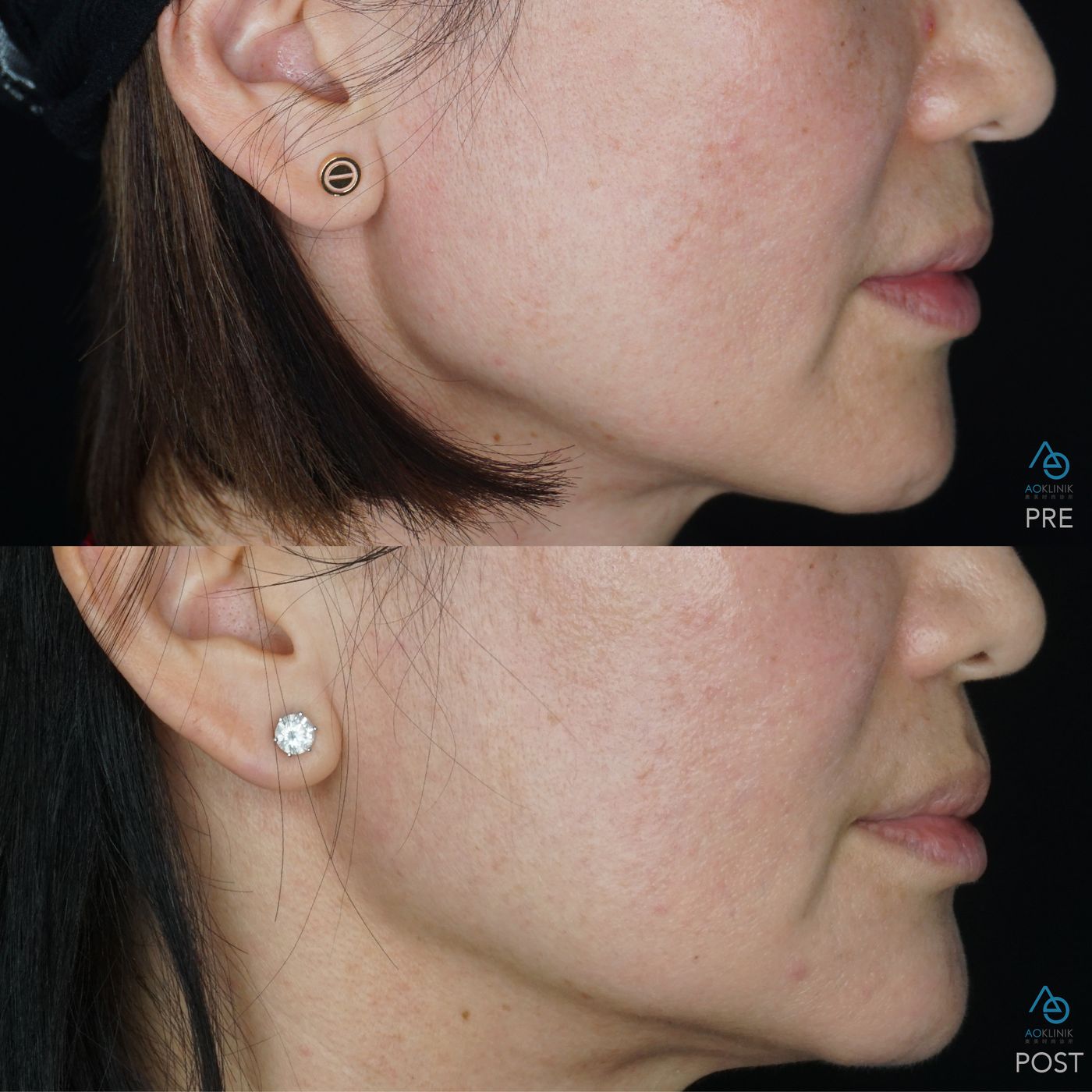 Radiesse Bio-Stimulation before and after at AOKLINIK Penang