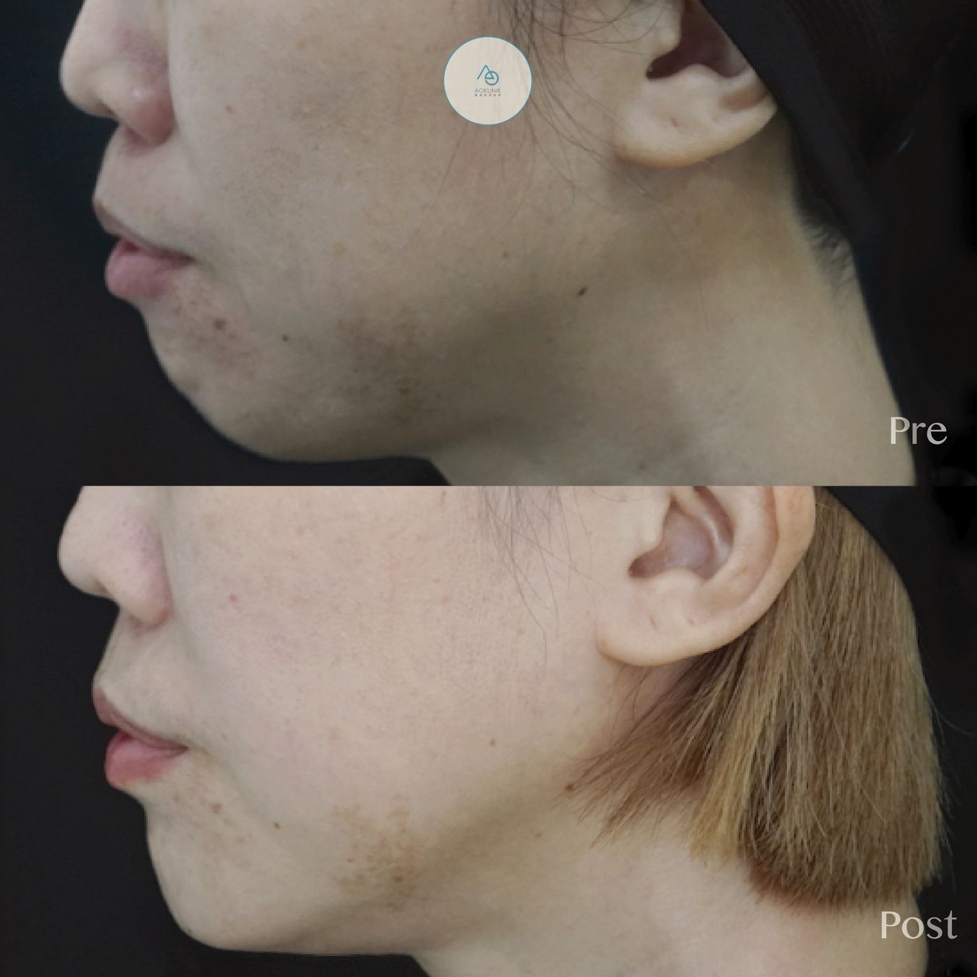 Restylane Chin Refinement before and after at AOKLINIK Penang