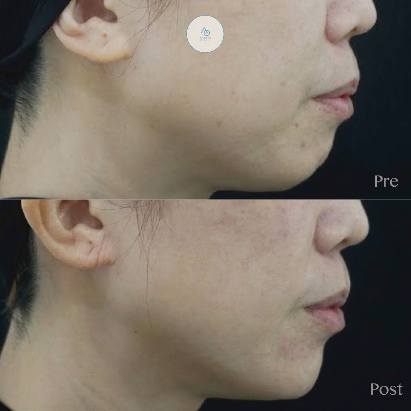 Restylane Chin Refinement before and after at AOKLINIK Penang