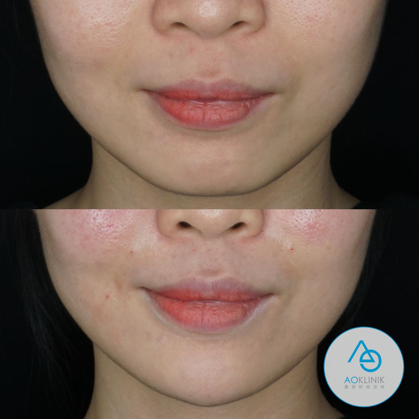 Restylane Chin Refinement before and after at AOKLINIK Penang