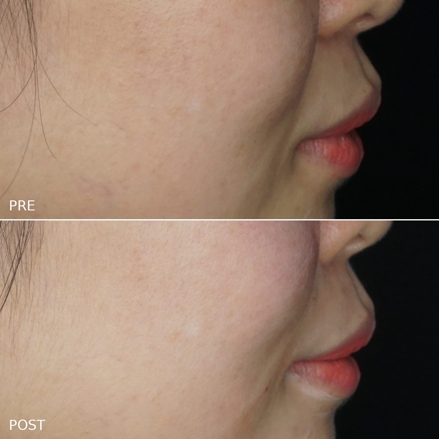 Restylane Profile Refinement before and after at AOKLINIK Penang